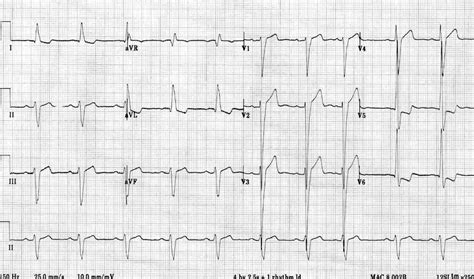 lv overload on ekg|left ventricular hypertrophy on ecg.